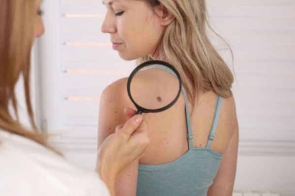 What Are Traditional Skin Lesion Removal Methods Buxton?