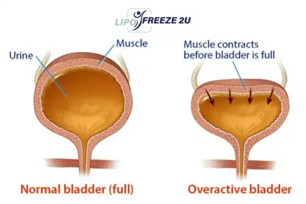 diagram of overactive bladder treatment Buxton