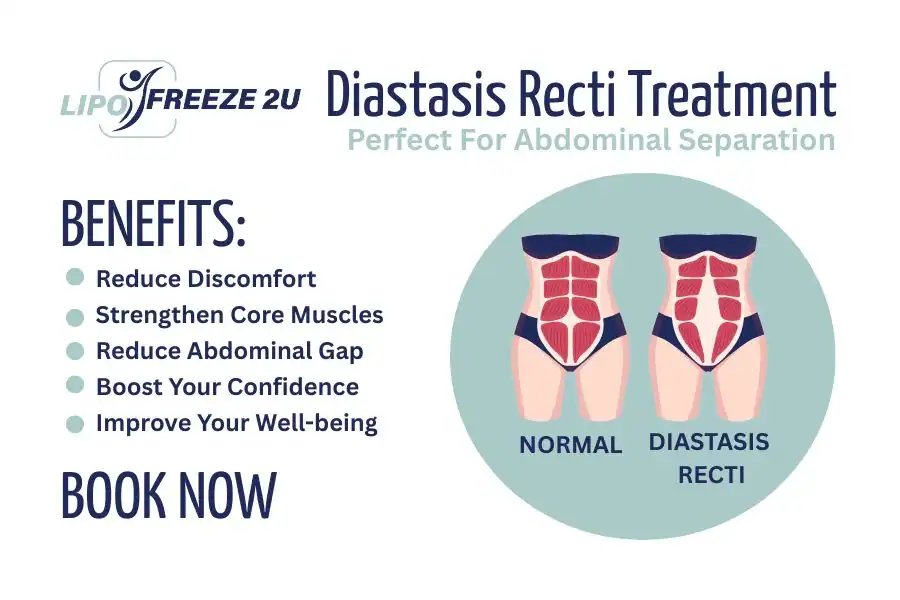 Benefits of body toning treatment Buxton for Diastasis recti
