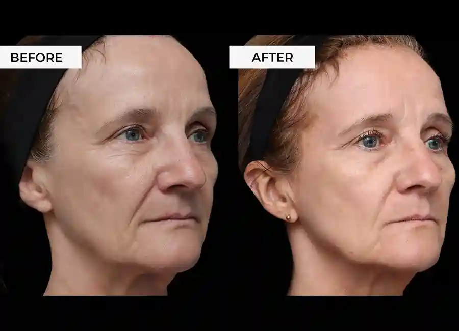 How Many RF Microneedling Sessions Will You Need to See a Difference Buxton?