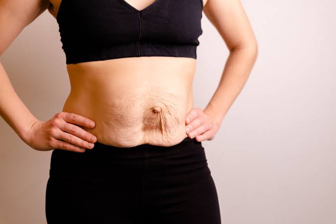 Is Surgery Really the Only Way to Repair Diastasis Recti Buxton?