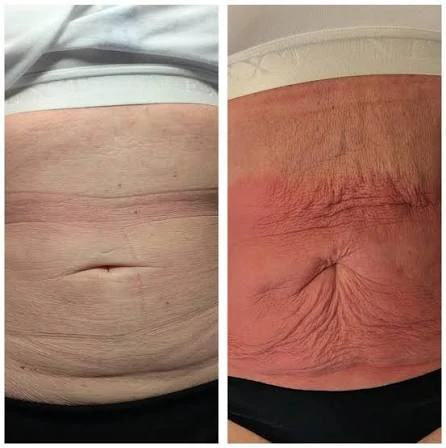 How Does RF Microneedling Improve Crepey, Thin and Uneven Skin Texture Buxton?