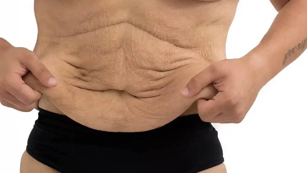 Why Does Weight Loss Medication Leave Some People With Loose or Sagging Skin Buxton?